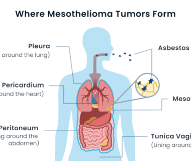 Mesothelioma