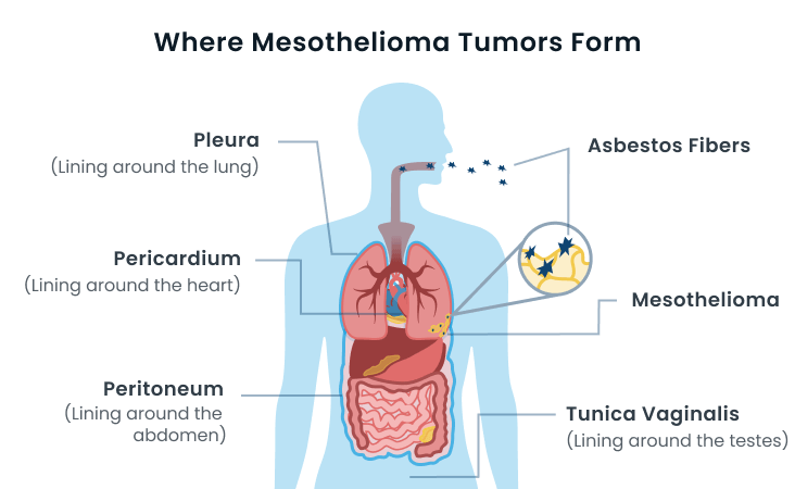 Mesothelioma